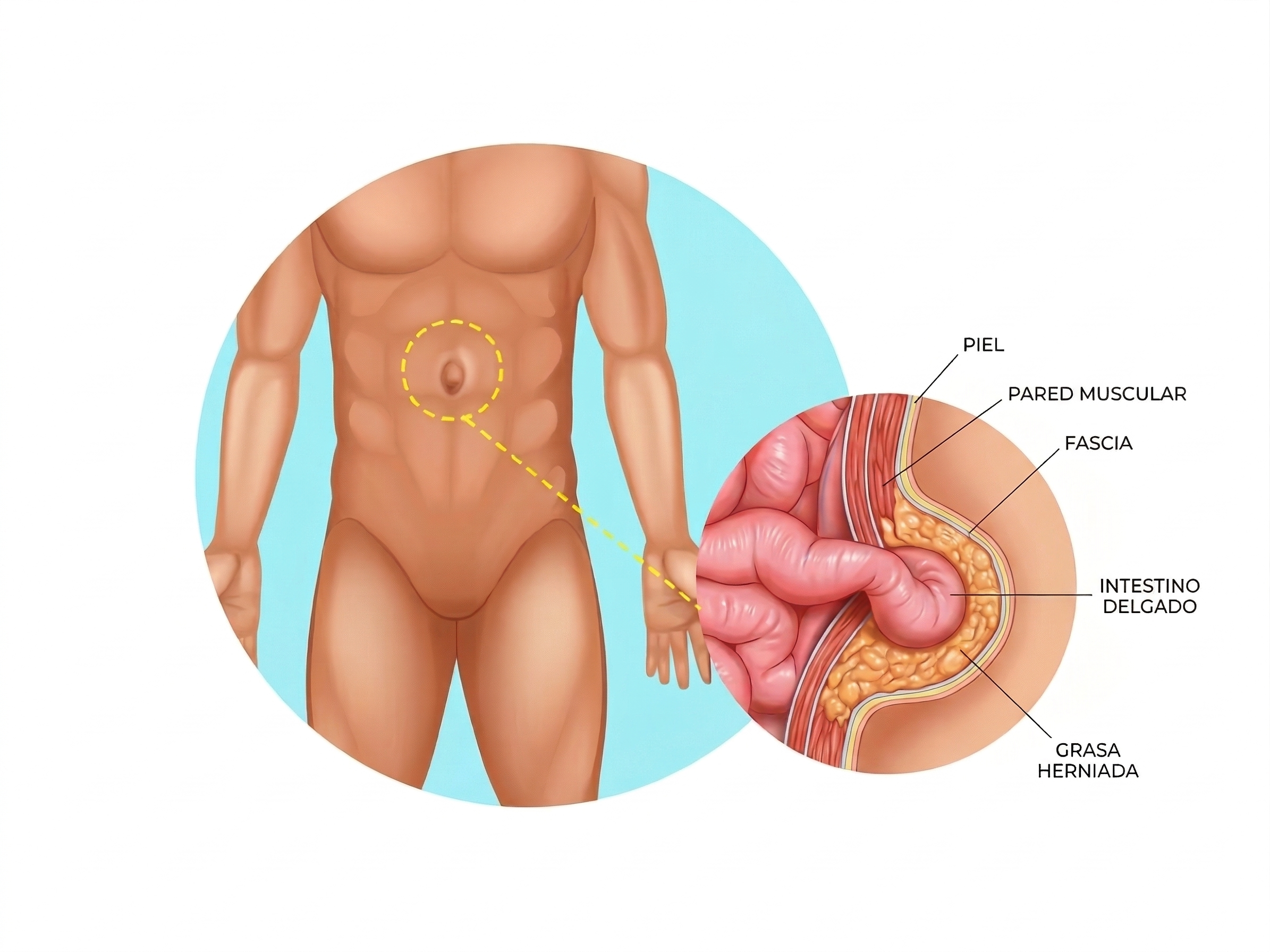 Hernias Ventrales